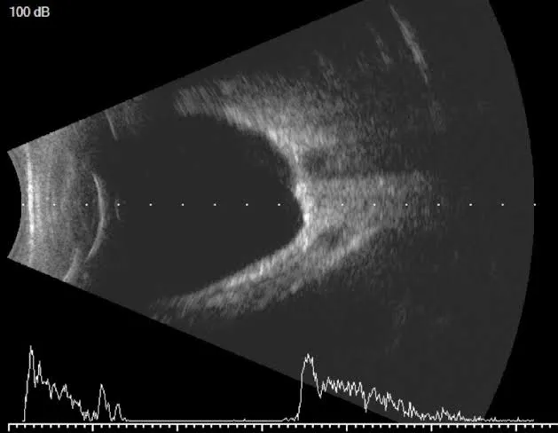 Échographie oculaire mode B : allongement du globe et staphylome