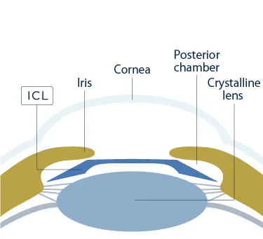 Schéma légendé de la position de l'implant phaque ICL : derrière l'iris, dans la chambre postérieure, devant le cristallin