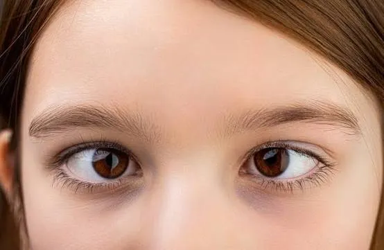 Yeux d'un enfant présentant un strabisme convergent (un œil dévié vers l'intérieur)
