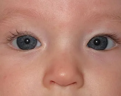 Visage d'un nourrisson présentant un strabisme convergent : l'œil gauche dévie vers le nez