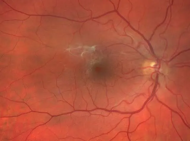Fond d'œil d'une membrane épirétinienne : reflet brillant et plis de la rétine autour de la macula