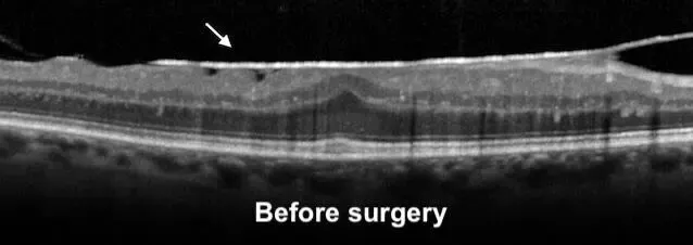 OCT maculaire avant chirurgie : la membrane épirétinienne (flèche) plisse et épaissit la macula
