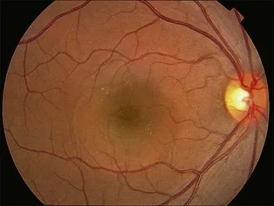 Fond d'œil d'une choriœrétinopathie séreuse centrale : zone de décollement séreux arrondie au niveau de la macula