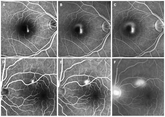 Séquence d'angiographie d'une CRSC : diffusion à partir du point de fuite