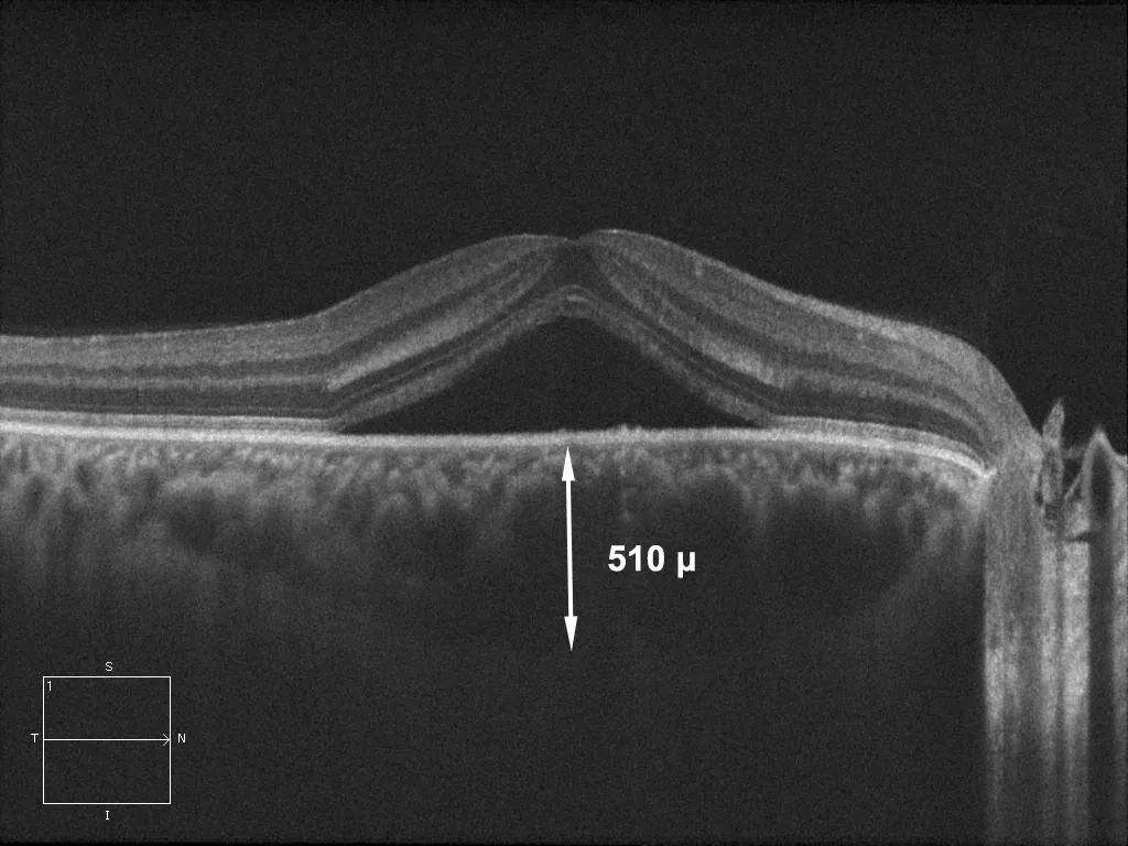 OCT maculaire d'une CRSC : décollement séreux de 510 µm