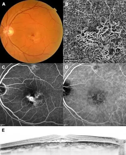 OCT-angiographie : réseau de néovaisseaux choroïdiens d'une CRSC compliquée