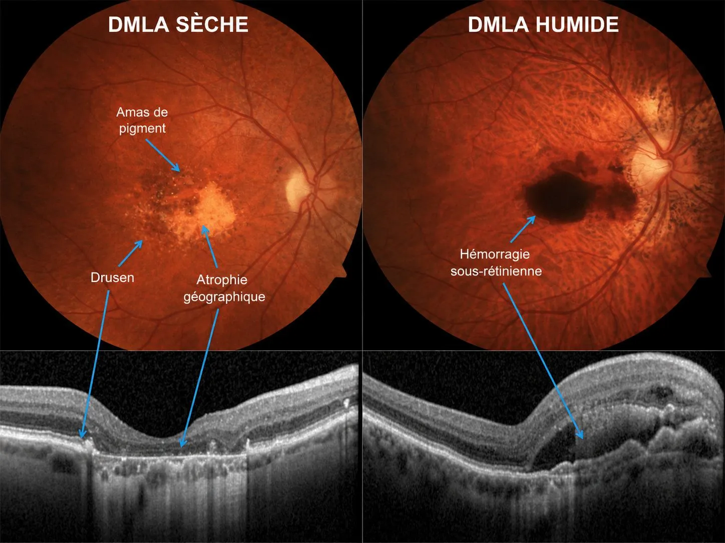 Comparaison DMLA sèche et humide : au fond d'œil, drusen, amas de pigment et atrophie géographique dans la forme sèche, hémorragie sous-rétinienne dans la forme humide ; en dessous, les coupes OCT correspondantes