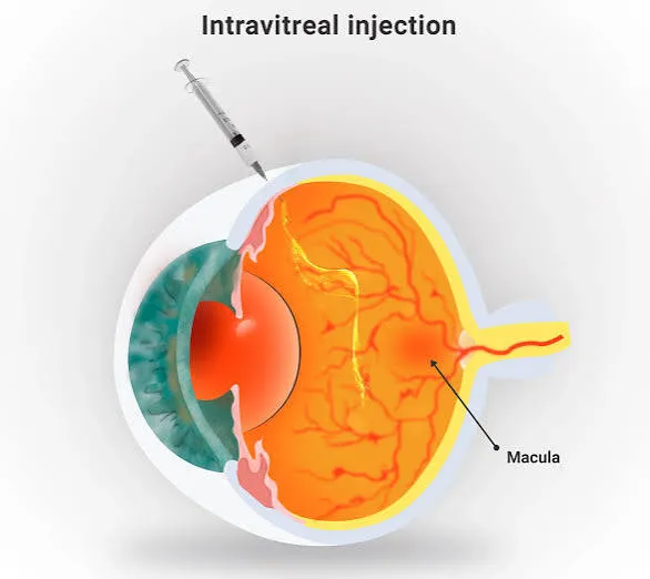 Schéma d'une injection intravitréenne : l'aiguille traverse la paroi de l'œil pour délivrer le traitement anti-VEGF dans le vitré, en regard de la macula