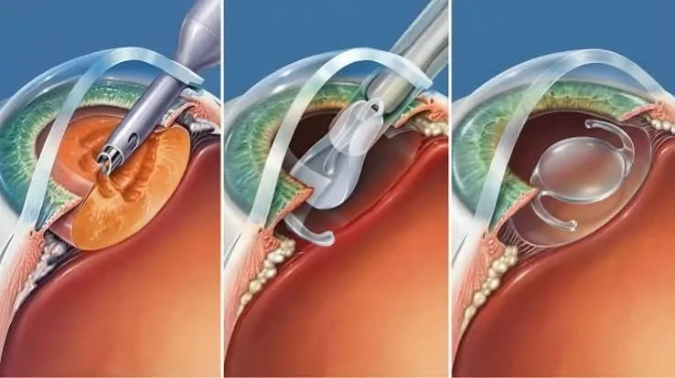 Les trois temps de la chirurgie de la cataracte : phacoémulsification du cristallin opacifié, insertion de l'implant intraoculaire plié, puis implant déplié et positionné dans le sac cristallinien