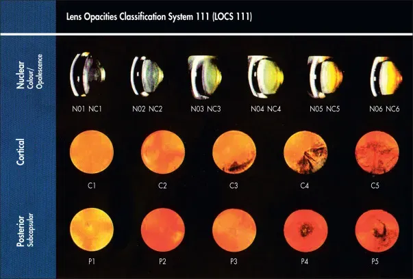 Classification LOCS III (Lens Opacities Classification System) : les trois localisations de la cataracte — nucléaire (N1 à N6), corticale (C1 à C5) et sous-capsulaire postérieure (P1 à P5), avec leurs degrés de sévérité croissants