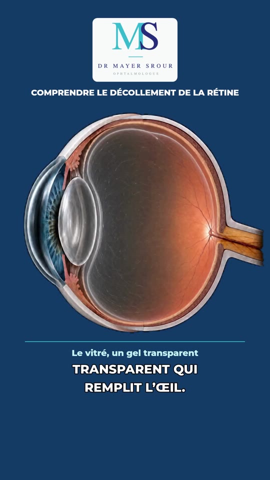 Schéma du vitré et de la rétine : décollement du vitré et corps flottants