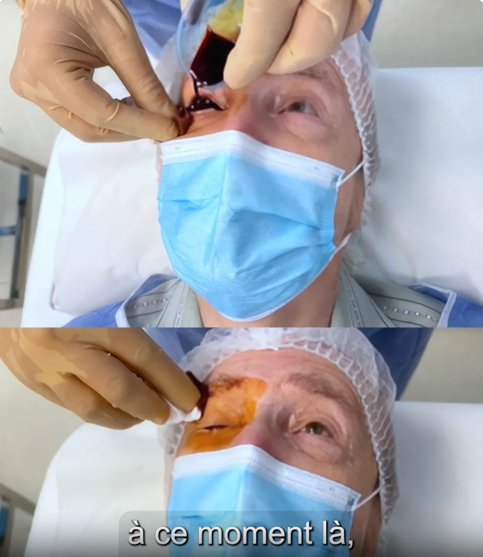 Injection intravitréenne réalisée au cabinet par le Dr Mayer Srour