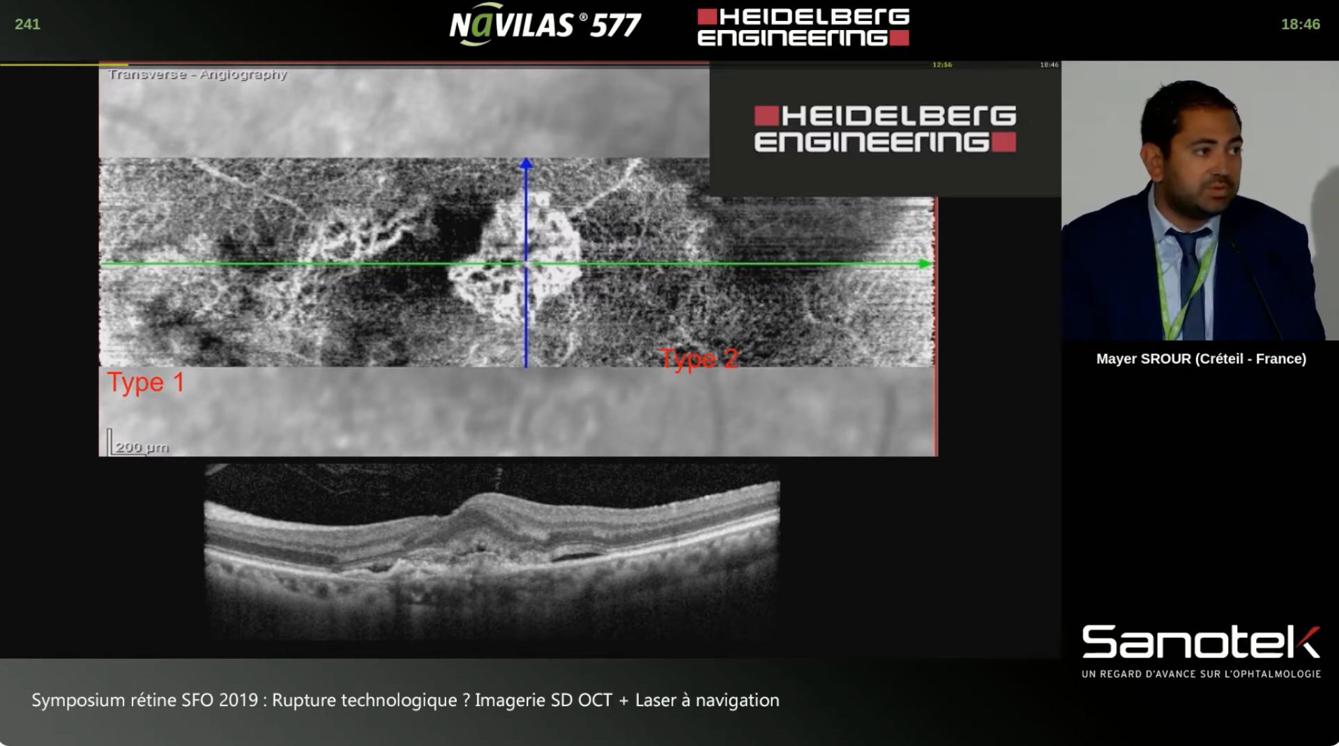 Dr Mayer Srour — cas cliniques OCT-A au SPECTRALIS (Symposium rétine SFO 2019)