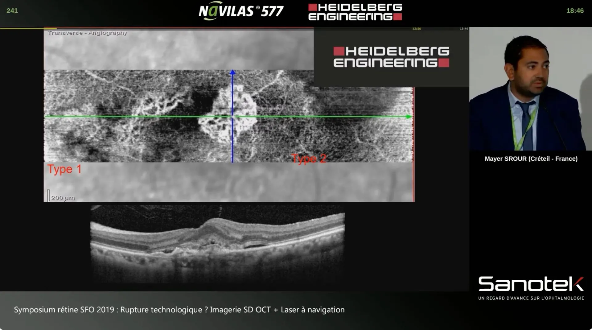 Dr Mayer Srour — cas cliniques OCT-A au SPECTRALIS (Symposium rétine SFO 2019)