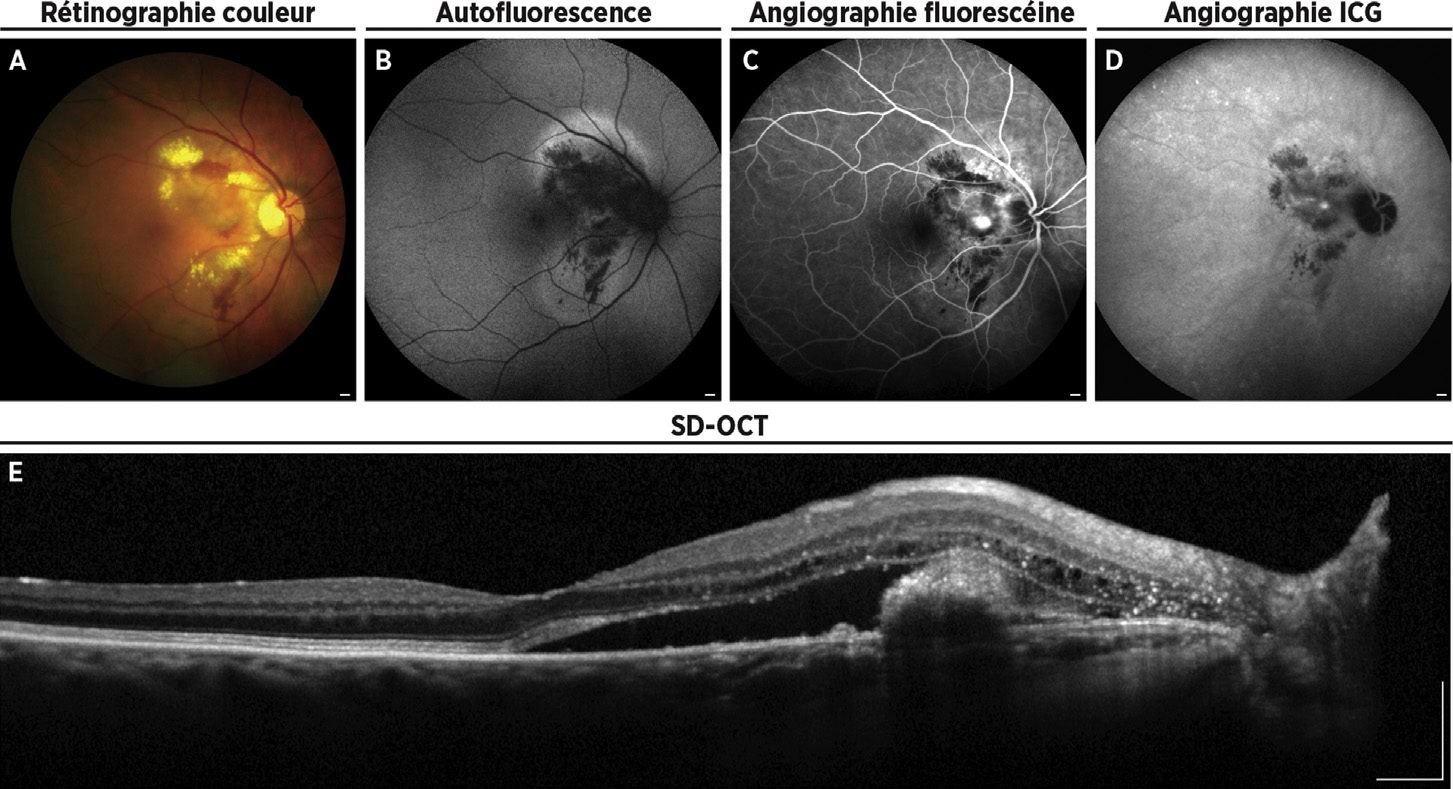 Vasculopatía coroidea polipoidea: retinografía, autofluorescencia, angiografía con fluoresceína e ICG, OCT