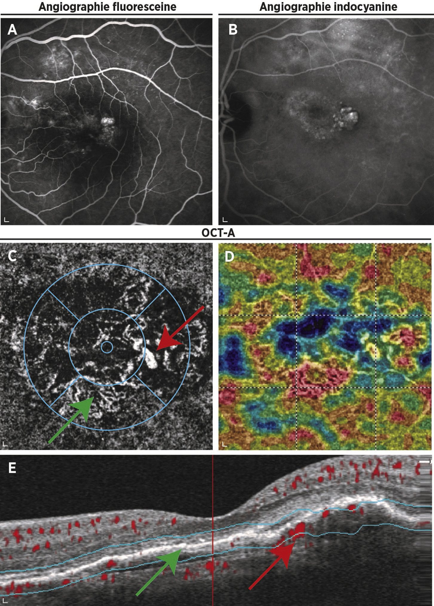 VCP en angiografía con fluoresceína, ICG y OCT-angiografía con red vascular anómala y pólipo