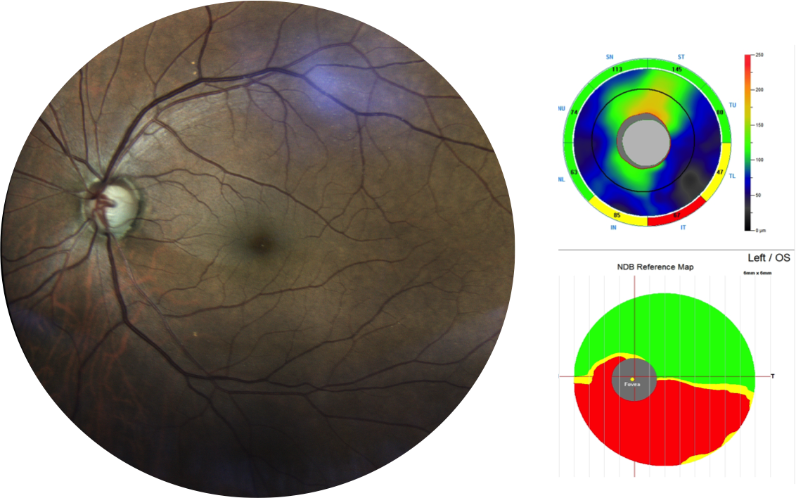 Glaucome chronique à angle ouvert